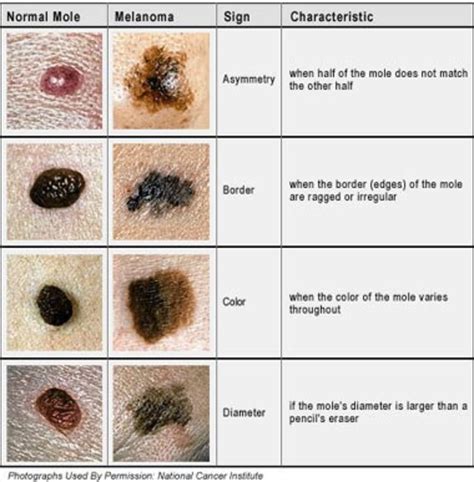 normal mole vs malignant melanoma